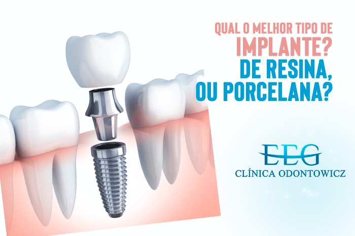 Qual o melhor tipo de implante? De resina, ou porcelana?