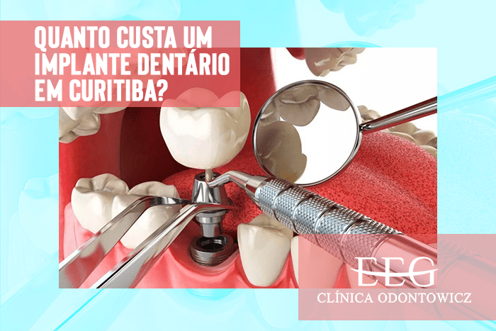 Quanto custa um implante dentário em Curitiba?