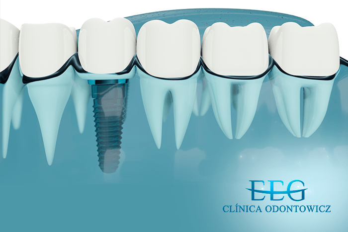 Indicações para um implante dentário