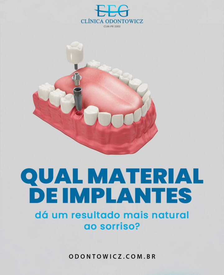 Qual material de implantes dá um resultado mais natural ao sorriso?