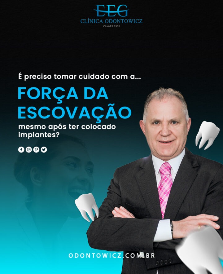 É preciso tomar cuidado com a força da escovação, mesmo após ter colocado implantes?